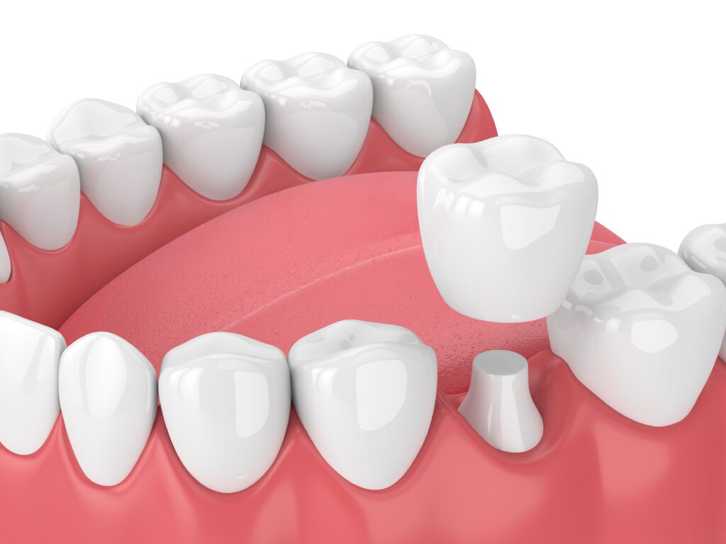 dental crowns Rocky River